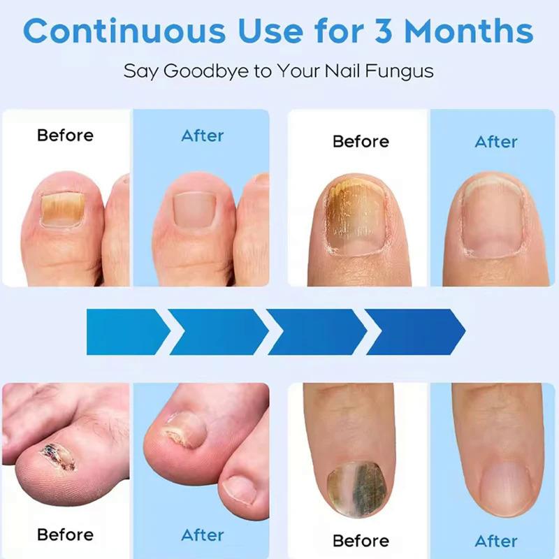 2025 New Nail Fungus Cleaning Device for Multiple Toenails & Fingernails