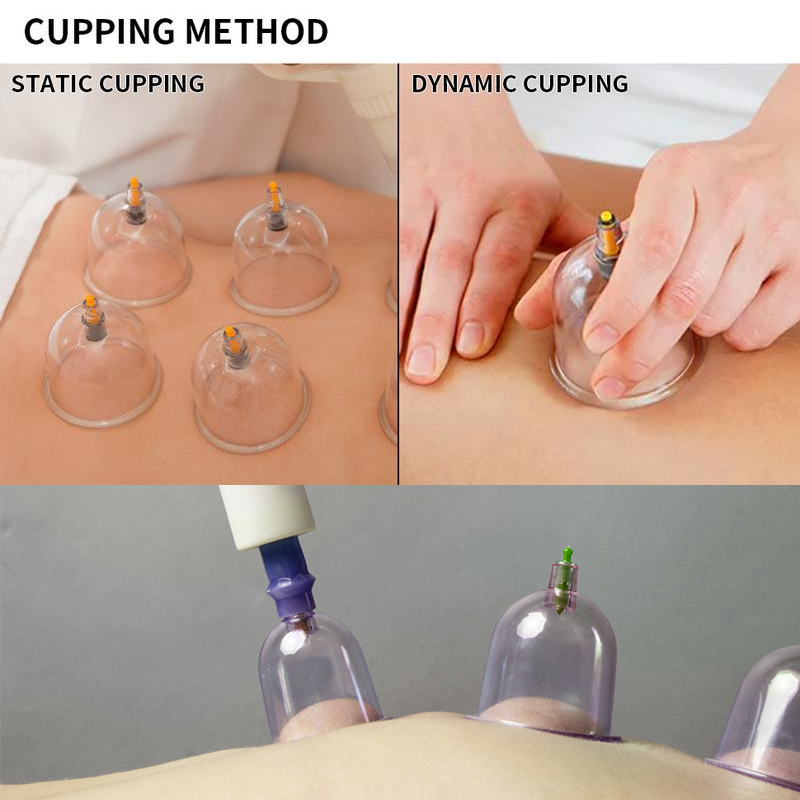 Cupping Kit for Massage Therapy