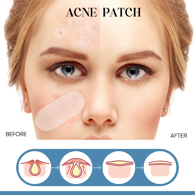 Acne Patches