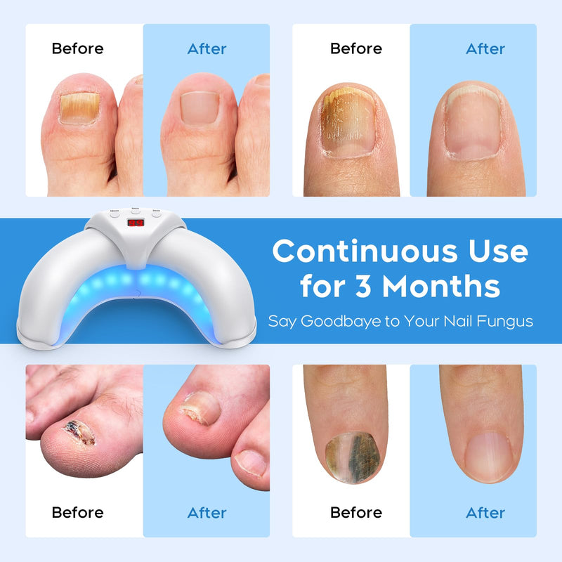 2025 New Nail Fungus Cleaning Device for Multiple Toenails & Fingernails