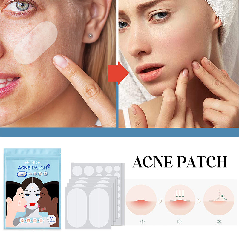 Acne Patches