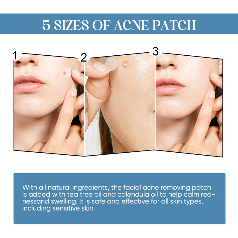 Acne Patches