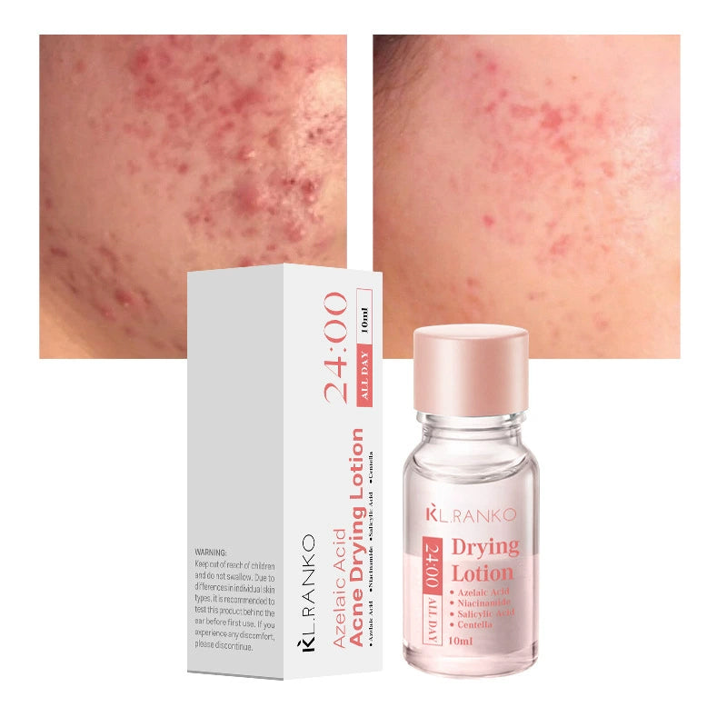 Salicylic Acid Acne Spot Treatment Serum – 10ml