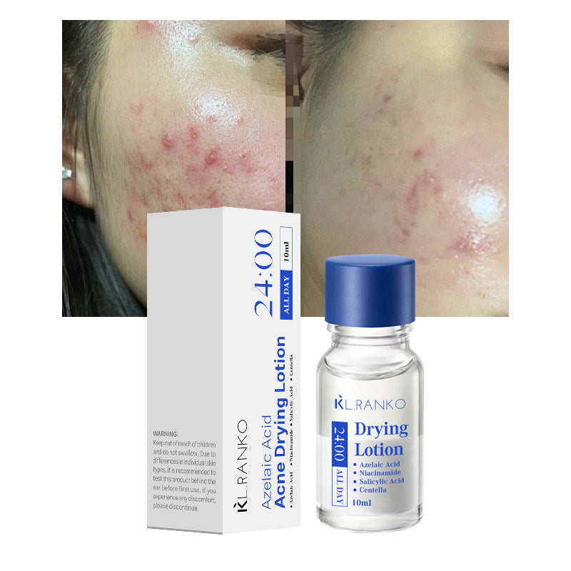 Salicylic Acid Acne Spot Treatment Serum – 10ml