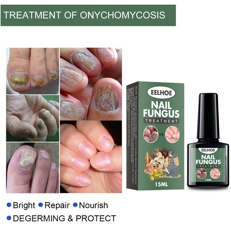 Fungal Nail Treatment