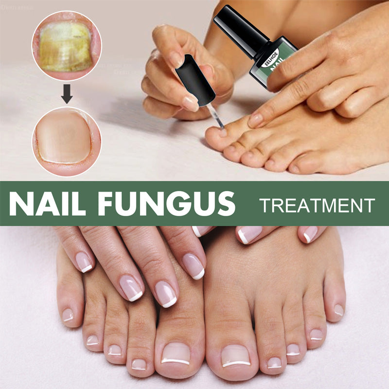 Fungal Nail Treatment