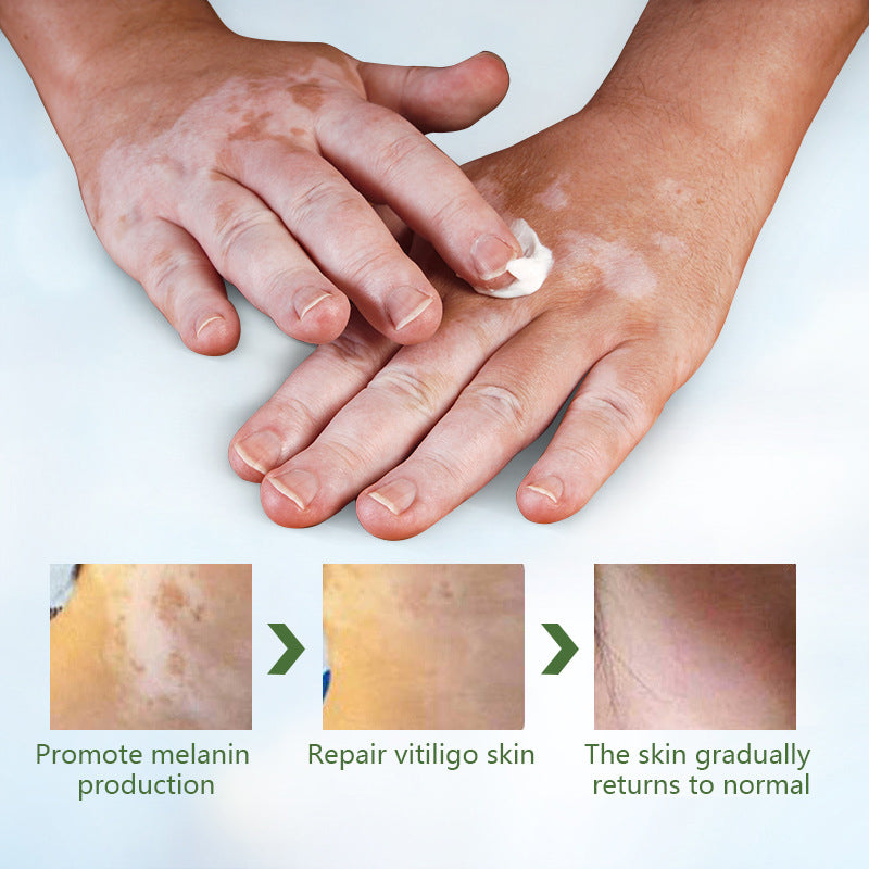 Vitiligo Health Repair Crem