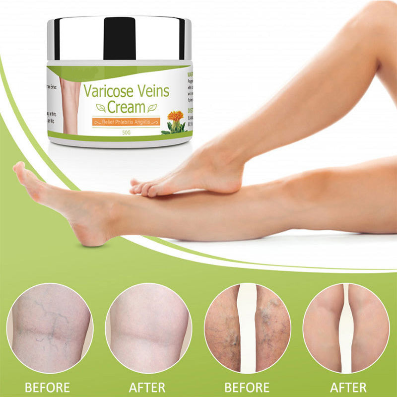 Varicose Vein Cream