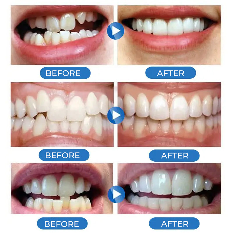 Practical Teeth Whitening Stickers