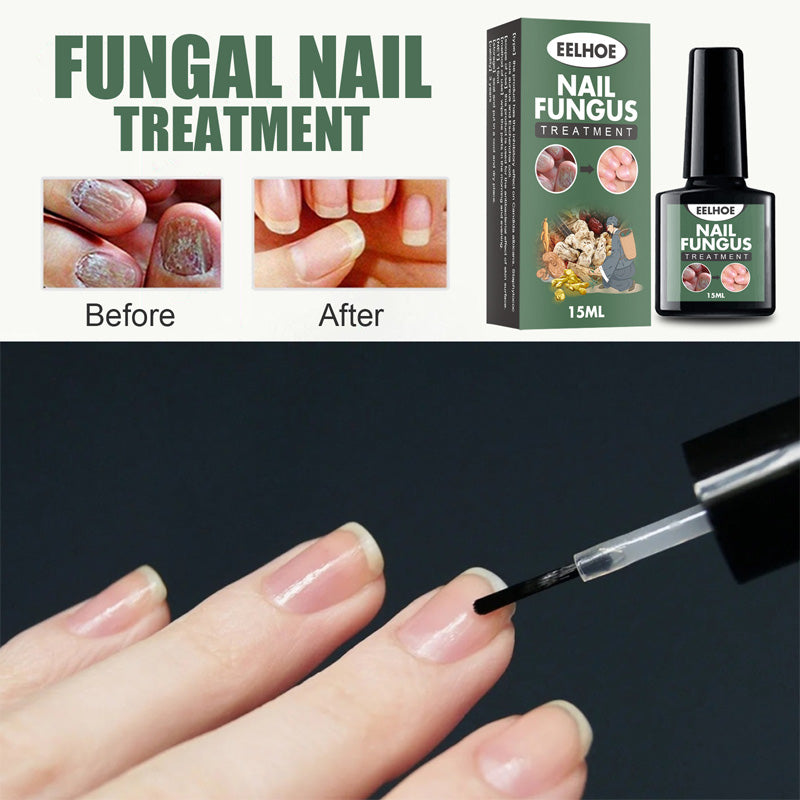 Fungal Nail Treatment